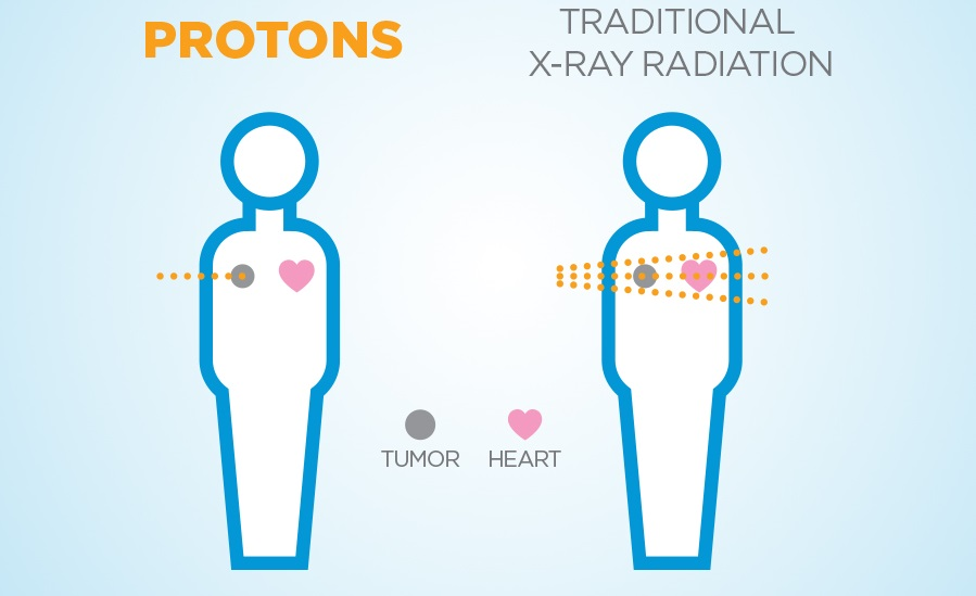 Tiềm năng phát triển công nghệ điều trị ung thư bằng xạ trị proton ở Việt Nam